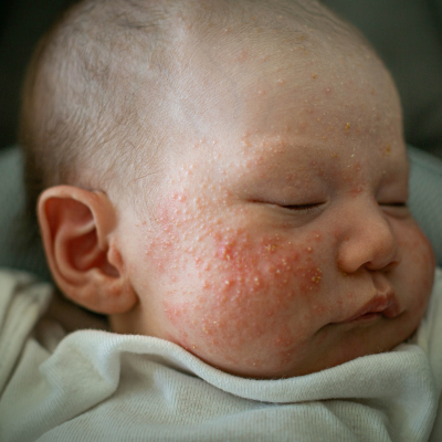This week is National Eczema Week